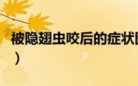 被隐翅虫咬后的症状图（被隐翅虫咬后的症状）