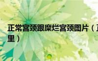 正常宫颈跟糜烂宫颈图片（正常宫颈图和宫颈糜烂区别在哪里）