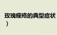 玫瑰痤疮的典型症状（玫瑰痤疮的初期的症状）