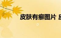皮肤有癣图片 皮癣的真实图片 