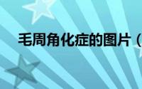 毛周角化症的图片（毛周角化症怎么治）