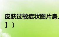 皮肤过敏症状图片身上（皮肤过敏症状【图片】）