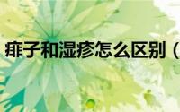 痱子和湿疹怎么区别（痱子和湿疹怎么区分）