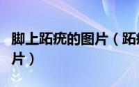 脚上跖疣的图片（跖疣长什么样子脚上跖疣图片）