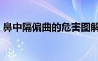 鼻中隔偏曲的危害图解（鼻中隔偏曲的危害）