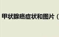 甲状腺癌症状和图片（甲状腺癌症状有哪些）