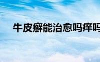 牛皮癣能治愈吗痒吗（牛皮癣能治愈吗）