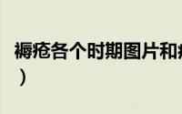 褥疮各个时期图片和症状（褥疮各个时期图片）