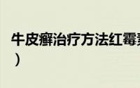 牛皮癣治疗方法红霉素软膏（牛皮癣治疗方法）