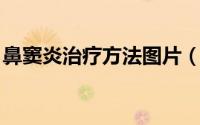 鼻窦炎治疗方法图片（鼻窦炎治疗方法 偏方）