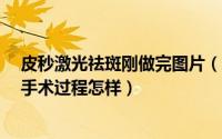 皮秒激光祛斑刚做完图片（激光祛斑恢复过程图/皮秒去斑手术过程怎样）
