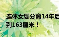 连体女婴分离14年后长成健康少女 身高都长到163厘米！