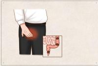 包头东大肛肠医院详解你的肛肠还好吗？简单５步自测肛肠健康