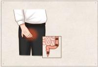 大同肛泰肛肠医院详解你的肛肠还好吗？简单５步自测肛肠健康
