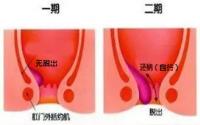 佛山肛泰医院：痔疮有自愈的可能性吗？日常应该如何护理呢？