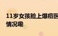 11岁女孩脸上爆痘医生开出避孕药 到底什么情况嘞